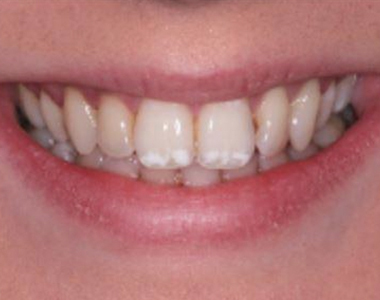 What You Need to Know About Fluorosis