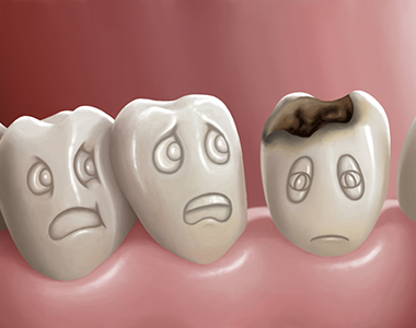 Cavities, or tooth decay