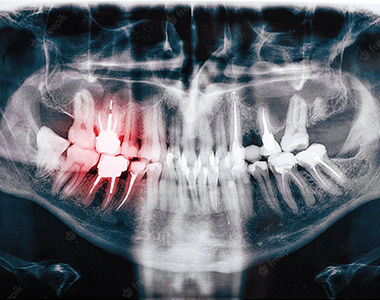 Dental x-ray