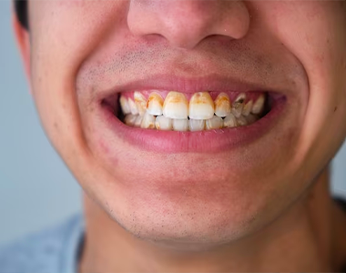 The Devastating Effects of Methamphetamine Use on Dental Health