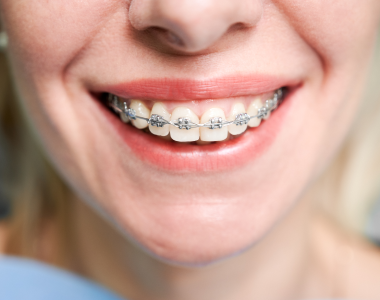 What To Know Before Getting Braces