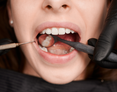 Common Signs You May Have a Cavity